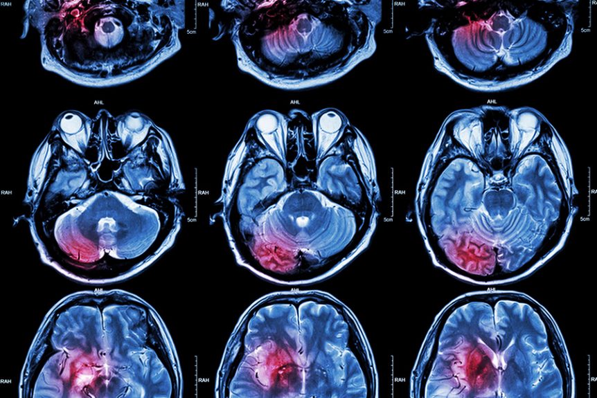 Stem cell treatment for brain injury stroke