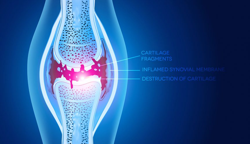 osteoarthritis damaged joint