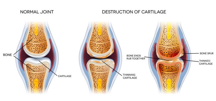 osteoarthritis graphic